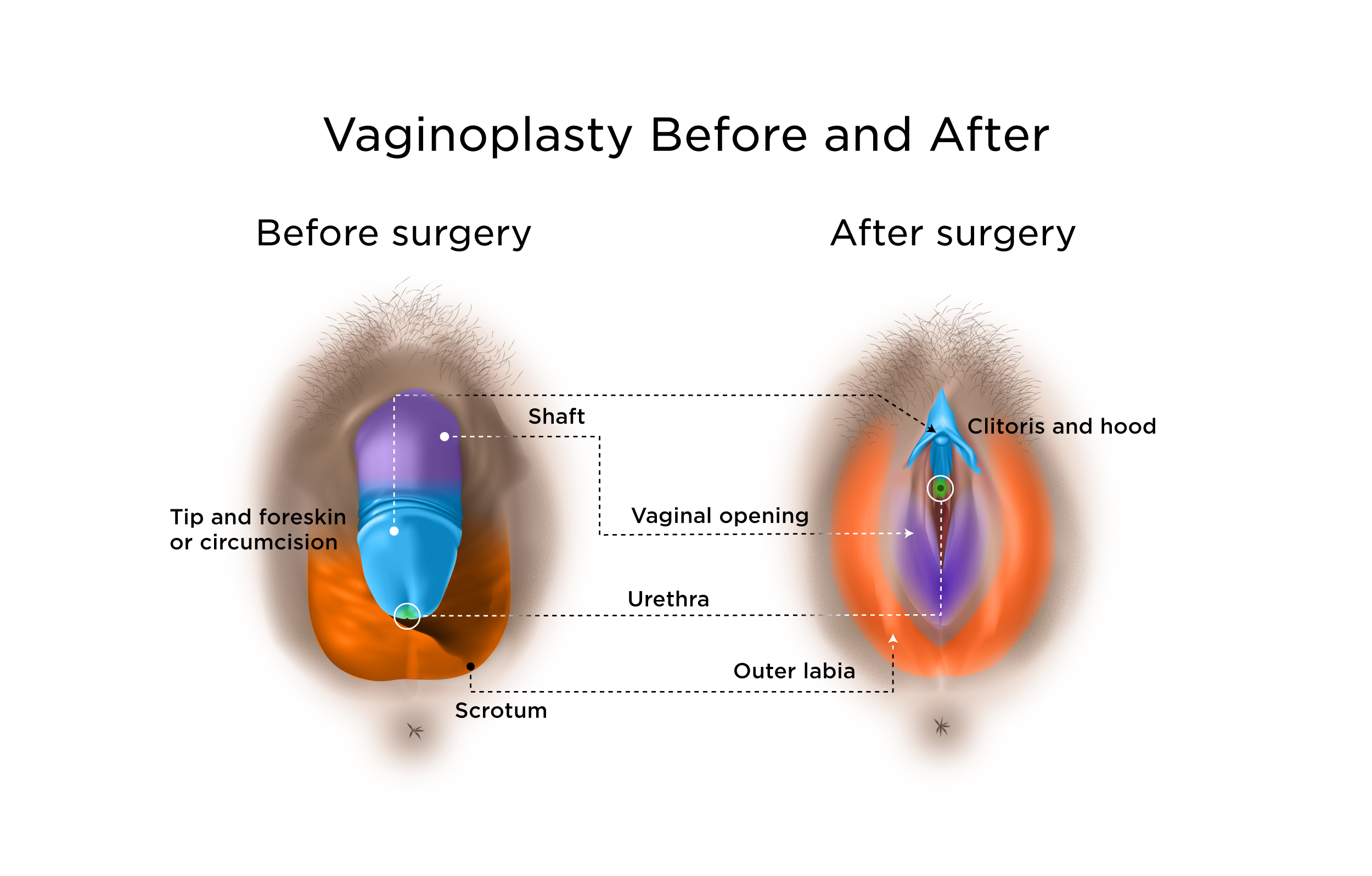 Vaginoplasty And Other Gender Affirming Genital Surgical Options My Doctor Online